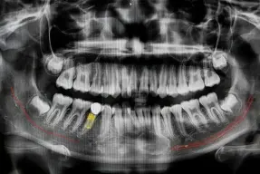 Panoramic dental X-ray showing full mouth teeth and jawbone structure for diagnostic imaging.