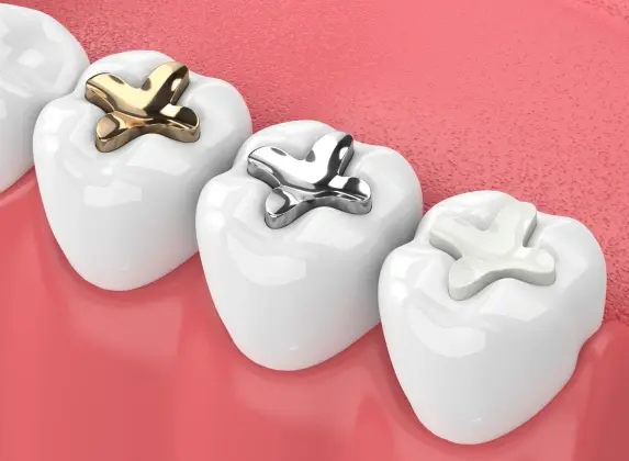 Three teeth with tooth-colored fillings in gold, silver, and white materials displayed against a pink background.